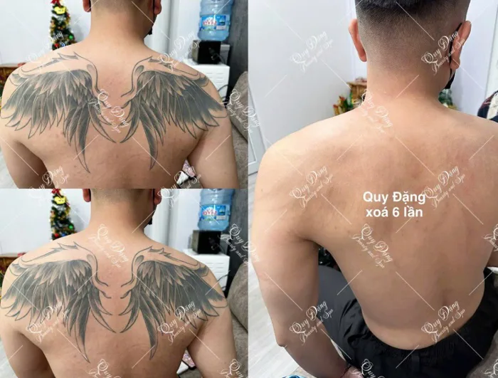 11 Địa chỉ xóa hình xăm tại Hà Nội uy tín nhiều người lựa chọn